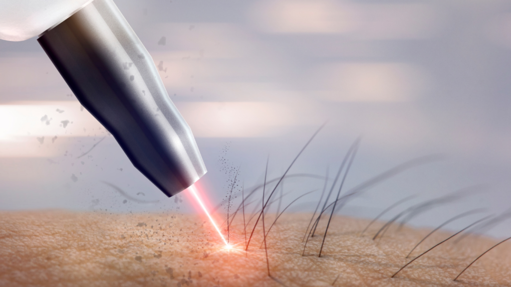 Laser Hair Removal for Sensitive Areas