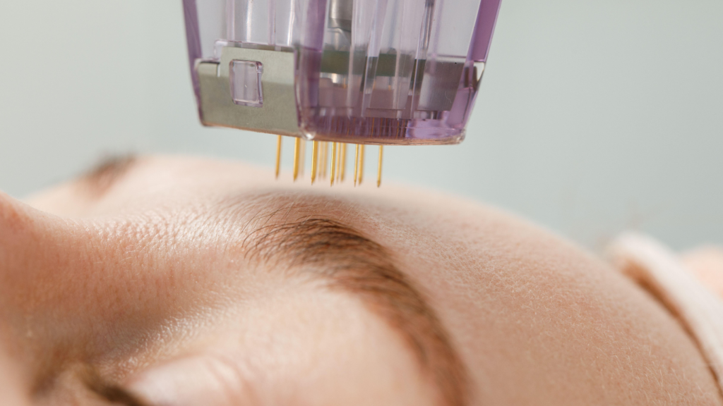 Microneedling and PRX: A Dynamic Duo for Long-Lasting Results