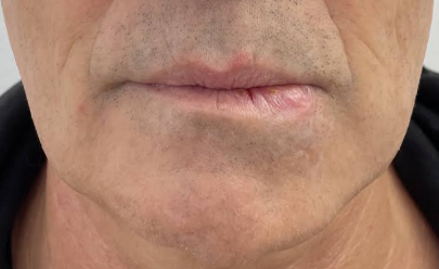 a women with lip asymmetry before lip filler treatment