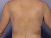 back fat before coolsculpting treatment
