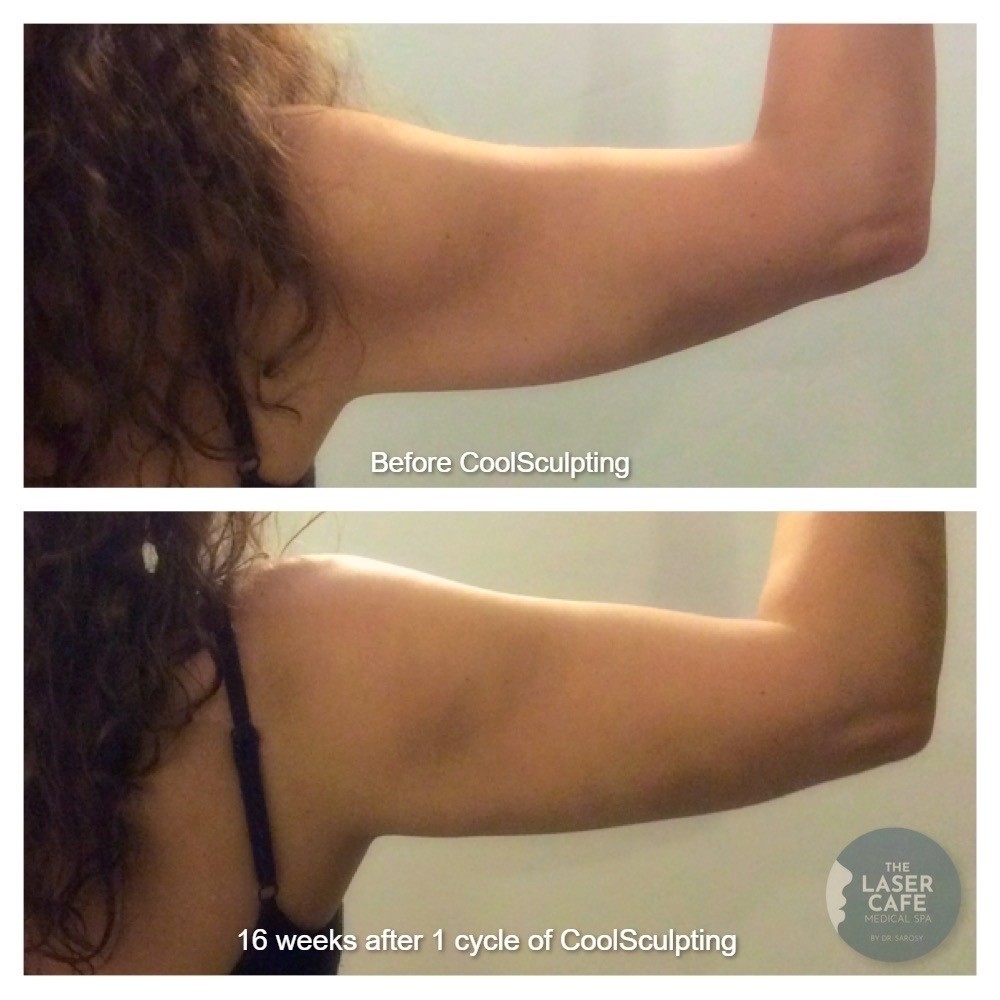 before and after image of arms after coolsculpting at the laser cafe