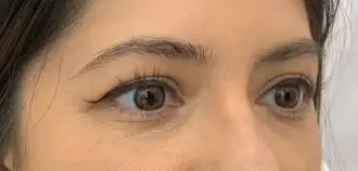 close up view of women with brow lift