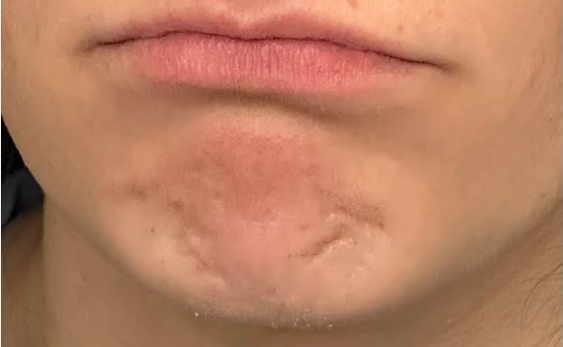 chin dumplings before xeomin treatment in san diego