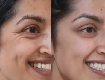 xeomin before and after photo treating crows feet