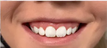gummy smile before jeuveau injection in san diego