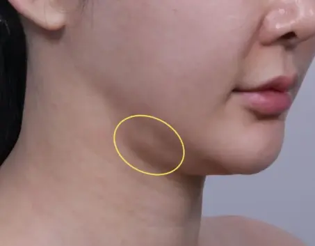 image with circle on submandibular area