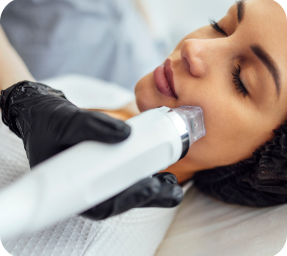Woman receiving a vivace treatment with a rf microneedling device.