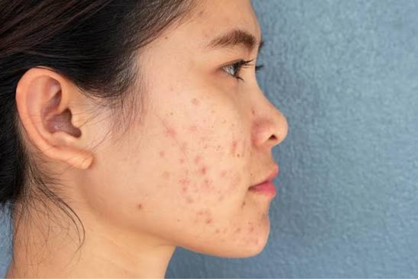 Side profile of a woman showing acne scars and uneven skin texture on the cheek