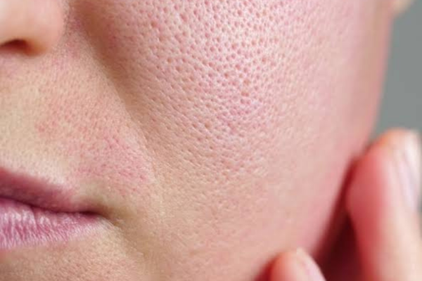 visible enlarged pores around the cheek and nose