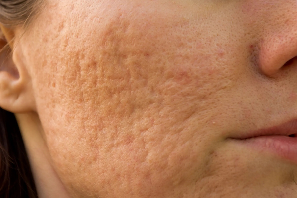 Close-up of facial skin showing rough and uneven skin texture