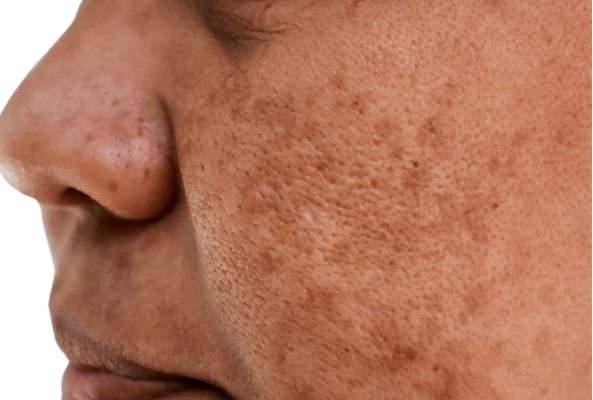 uneven pigmentation and an inconsistent skin tone
