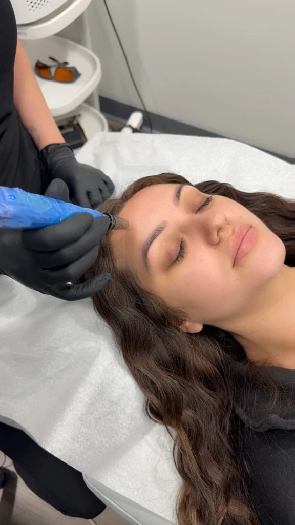 rejuvapen microneedling session at the laser cafe