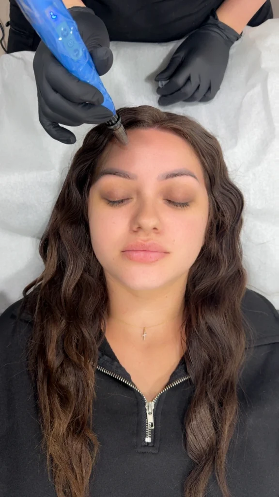 ongoing rejuvapen microneedling session in san diego