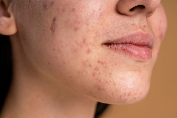 women with acne scars