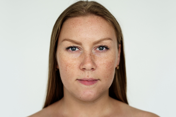 women with hyperpigmentation