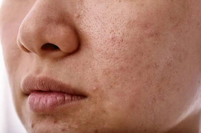 dull skin before skinvive treatment