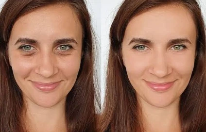 loss of smoothness in cheeks before and after skinvive treatment