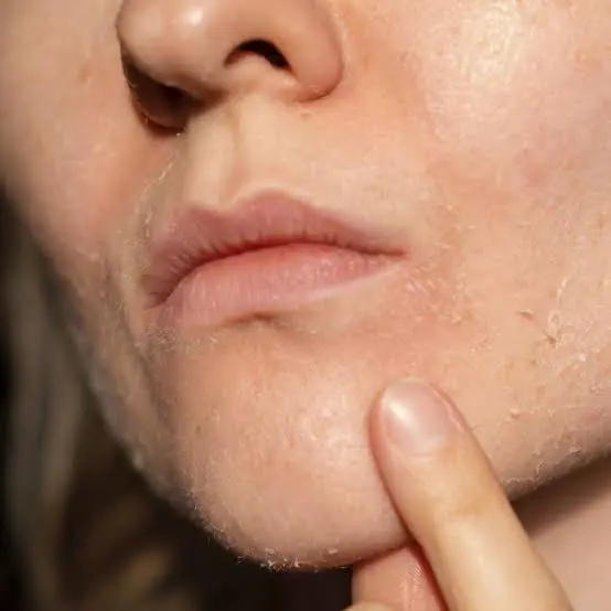 skin dehydration