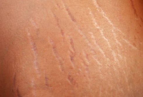 stretch marks