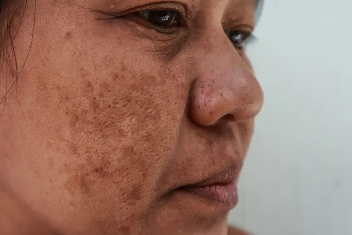 sun damage