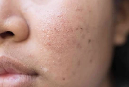 uneven skin tone